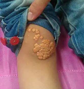 Een foto van de knie van een patiënt, waarop meerdere xanthoma tuberosum zichtbaar zijn.